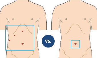 Gastric sleeve