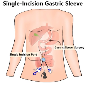 Gastric sleeve